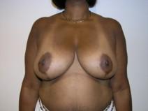 Breast Reduction After Photo by Joseph Fodero, MD; Florham Park, NJ - Case 7289