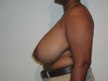 Breast Reduction Before Photo by Joseph Fodero, MD; Florham Park, NJ - Case 7289