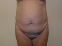 Tummy Tuck Before Photo by Joseph Fodero, MD; Florham Park, NJ - Case 7321