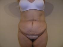 Tummy Tuck Before Photo by Joseph Fodero, MD; Florham Park, NJ - Case 7322