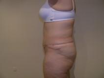 Tummy Tuck After Photo by Joseph Fodero, MD; Florham Park, NJ - Case 7322
