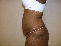 Tummy Tuck Before Photo by Joseph Fodero, MD; Florham Park, NJ - Case 7323