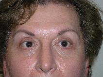 Eyelid Surgery After Photo by Joseph Fodero, MD; Florham Park, NJ - Case 7672