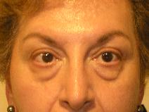 Eyelid Surgery Before Photo by Joseph Fodero, MD; Florham Park, NJ - Case 7672