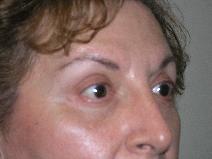 Eyelid Surgery After Photo by Joseph Fodero, MD; Florham Park, NJ - Case 7672