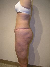 Liposuction After Photo by Joseph Fodero, MD; Florham Park, NJ - Case 7676