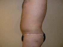 Liposuction After Photo by Joseph Fodero, MD; Florham Park, NJ - Case 7677
