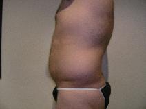Liposuction Before Photo by Joseph Fodero, MD; Florham Park, NJ - Case 7677
