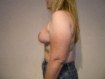 Breast Reduction After Photo by Joseph Fodero, MD; Florham Park, NJ - Case 8576