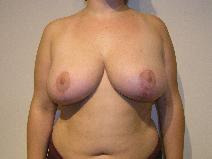 Breast Reduction After Photo by Joseph Fodero, MD; Florham Park, NJ - Case 8577