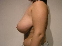 Breast Reduction Before Photo by Joseph Fodero, MD; Florham Park, NJ - Case 8577