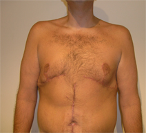 Breast Reduction Before and After Photos by Joseph Fodero, MD; Florham  Park, NJ - Case 8578