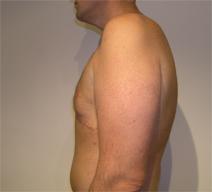 Breast Reduction After Photo by Joseph Fodero, MD; Florham Park, NJ - Case 8578