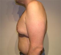 Breast Reduction Before Photo by Joseph Fodero, MD; Florham Park, NJ - Case 8578
