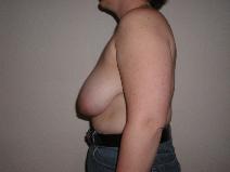 Breast Reduction Before Photo by Joseph Fodero, MD; Florham Park, NJ - Case 8612