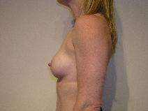 Breast Augmentation After Photo by Joseph Fodero, MD; Florham Park, NJ - Case 8613