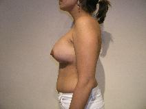 Breast Augmentation After Photo by Joseph Fodero, MD; Florham Park, NJ - Case 8616