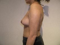Breast Augmentation Before Photo by Joseph Fodero, MD; Florham Park, NJ - Case 8616