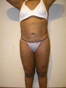 Liposuction After Photo by Joseph Fodero, MD; Florham Park, NJ - Case 8619