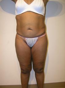 Liposuction Before Photo by Joseph Fodero, MD; Florham Park, NJ - Case 8619