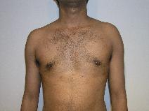 Male Breast Reduction After Photo by Joseph Fodero, MD; Florham Park, NJ - Case 9069