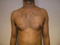 Male Breast Reduction Before Photo by Joseph Fodero, MD; Florham Park, NJ - Case 9069
