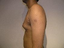 Male Breast Reduction Before Photo by Joseph Fodero, MD; Florham Park, NJ - Case 9069