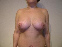Breast Lift After Photo by Joseph Fodero, MD; Florham Park, NJ - Case 9076
