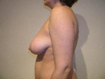 Breast Lift Before Photo by Joseph Fodero, MD; Florham Park, NJ - Case 9076
