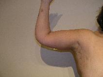 Arm Lift After Photo by Joseph Fodero, MD; Florham Park, NJ - Case 9086