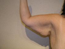 Arm Lift Before Photo by Joseph Fodero, MD; Florham Park, NJ - Case 9086