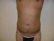Liposuction After Photo by Joseph Fodero, MD; Florham Park, NJ - Case 9091