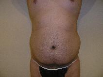 Liposuction Before Photo by Joseph Fodero, MD; Florham Park, NJ - Case 9091