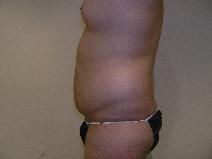 Liposuction Before Photo by Joseph Fodero, MD; Florham Park, NJ - Case 9091