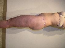Liposuction After Photo by Joseph Fodero, MD; Florham Park, NJ - Case 9092