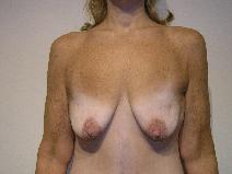Breast Augmentation Before Photo by Joseph Fodero, MD; Florham Park, NJ - Case 9106