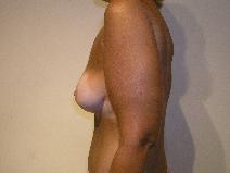 Breast Augmentation After Photo by Joseph Fodero, MD; Florham Park, NJ - Case 9106