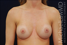 Breast Augmentation After Photo by Michael Law, MD; Raleigh, NC - Case 23776