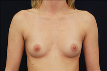 Breast Augmentation Before Photo by Michael Law, MD; Raleigh, NC - Case 23776