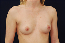 Breast Augmentation Before Photo by Michael Law, MD; Raleigh, NC - Case 23776