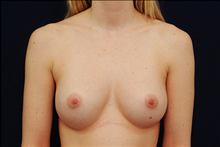 Breast Augmentation After Photo by Michael Law, MD; Raleigh, NC - Case 23777