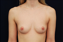 Breast Augmentation Before Photo by Michael Law, MD; Raleigh, NC - Case 23777