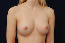 Breast Augmentation After Photo by Michael Law, MD; Raleigh, NC - Case 23777
