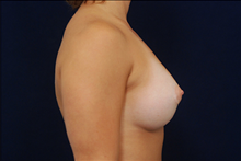 Breast Augmentation After Photo by Michael Law, MD; Raleigh, NC - Case 23778