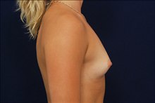 Breast Augmentation Before Photo by Michael Law, MD; Raleigh, NC - Case 23778