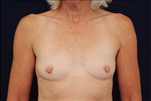 Breast Augmentation Before Photo by Michael Law, MD; Raleigh, NC - Case 23779