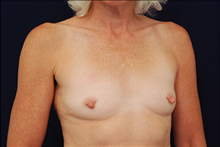 Breast Augmentation Before Photo by Michael Law, MD; Raleigh, NC - Case 23779