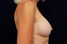 Breast Augmentation After Photo by Michael Law, MD; Raleigh, NC - Case 23779