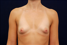 Breast Augmentation Before Photo by Michael Law, MD; Raleigh, NC - Case 23780