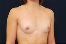 Breast Augmentation Before Photo by Michael Law, MD; Raleigh, NC - Case 23782